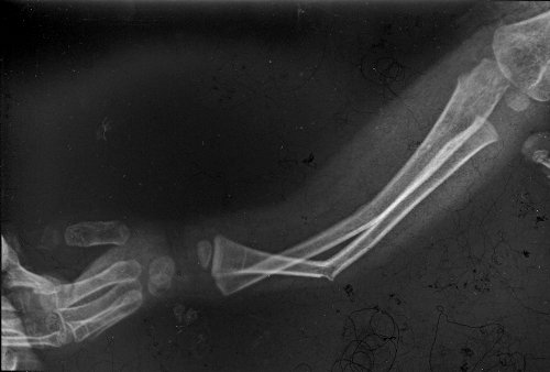 X-ray of Alice's right arm.