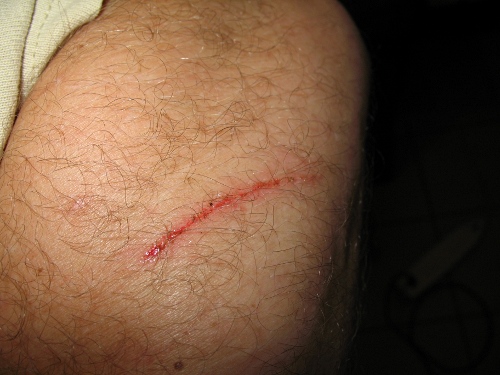 Nick (4cm) on my left upper arm, caused by a machete.
